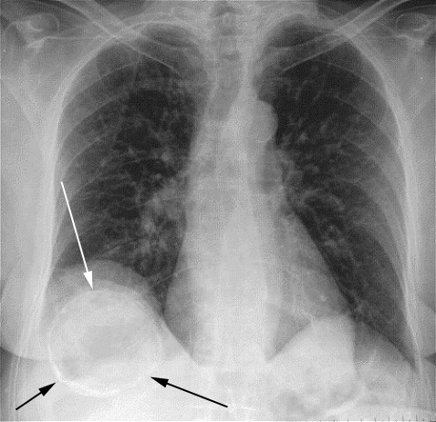afbeelding Vossenlintworm