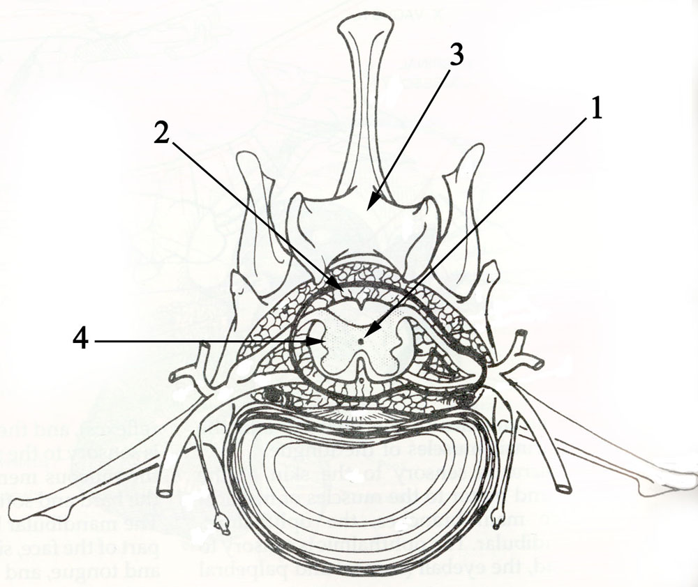 afbeelding Syringomyelie