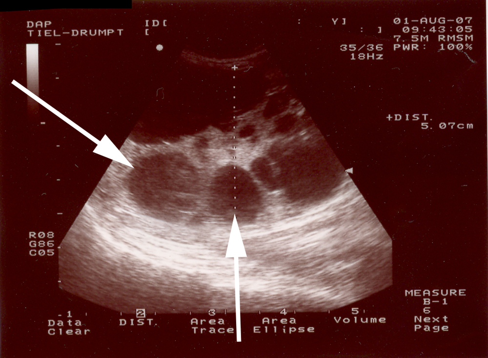 Dit is een echo plaatje van een katten-nier. Er is echter weinig normaal nierweefsel meer aanwezig; bijna alles is vervangen door grote met vocht gevulde holtes (zie de pijlen).
