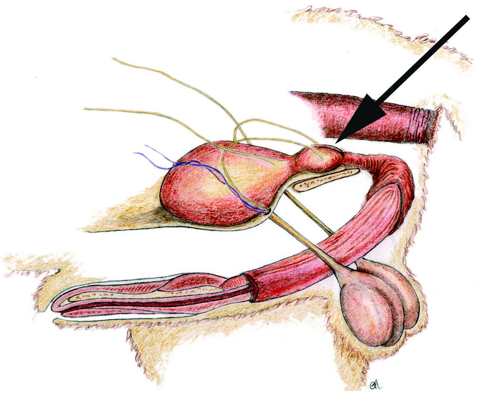 afbeelding Prostaatproblemen