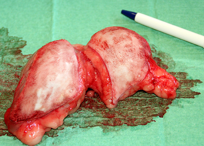 Het bleken 2 grote bulten gevuld met vocht te zijn.