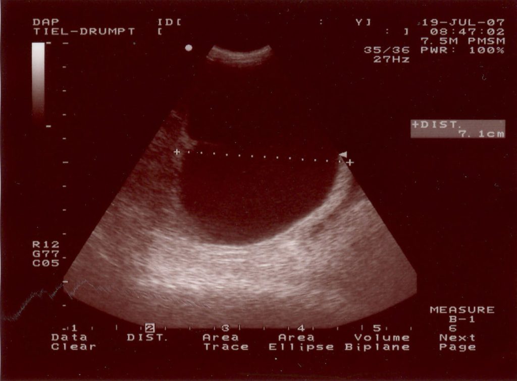 Een cyste in de binnenbal.