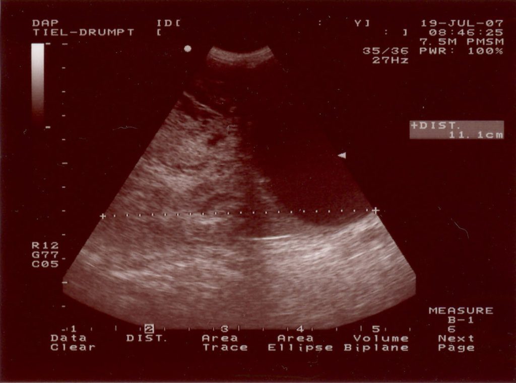 Een echo plaatje van de binnenbal.