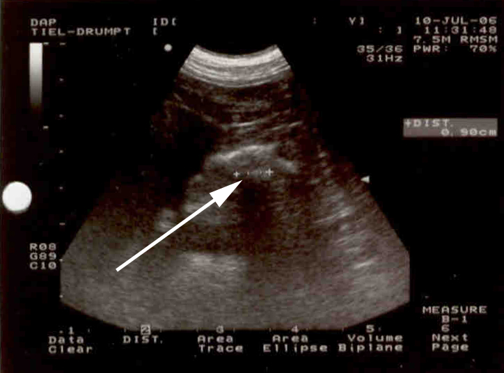 Ook met de echo kregen we een verdenking van een voorwerp in de maag.