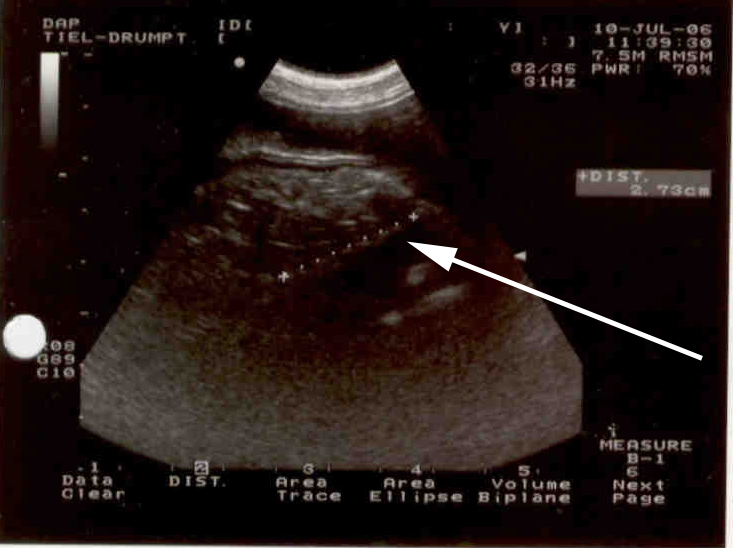 Afhankelijk van de positie leek breder of smaller waardoor er een verdenking was van een langwerpige structuur.
