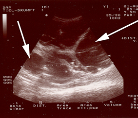 afbeelding Polycystic Kidney Disease (PKD)