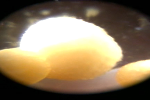 afbeelding Het verwijderen van blaasstenen met de scoop