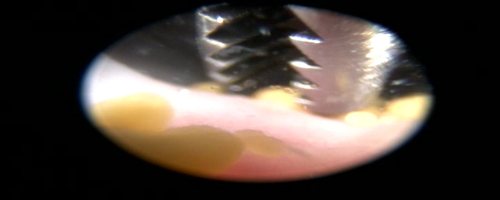 Dierenkliniek Tiel-Drumpt: Met behulp van een grijper kon de dierenarts de blaassteentjes verwijderen bij het hondje.