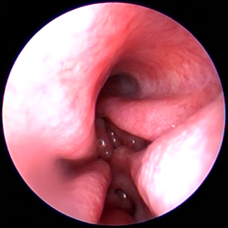 afbeelding Rhinoscopie of neusscopie