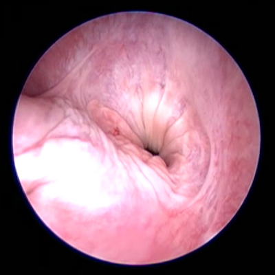 afbeelding Vaginoscopie