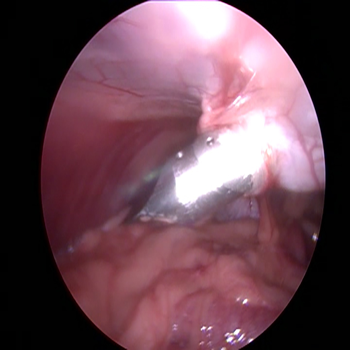 Dierenkliniek Tiel-Drumpt: Laparoscopische sterilisatie bij de hond: Gezien de scherpe punt van de achterste trocar, is een lege blaas aan te bevelen.