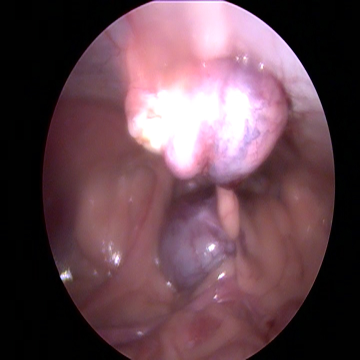 Dierenkliniek Tiel-Drumpt: Laparoscopische sterilisatie bij de hond: De eierstokken worden via het achterste gaatje verwijderd.