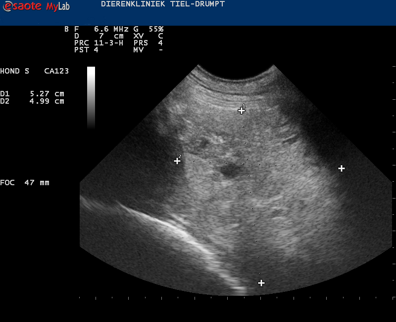 afbeelding Prostaattumoren