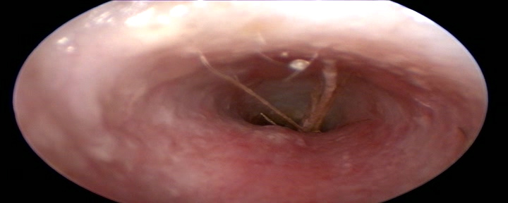 Dierenkliniek Tiel-Drumpt: Grasaar door het trommelvlies van een hond.