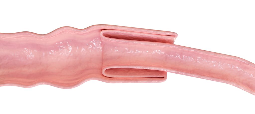 afbeelding Darm-in-darm verschuiving ( darminvaginatie )