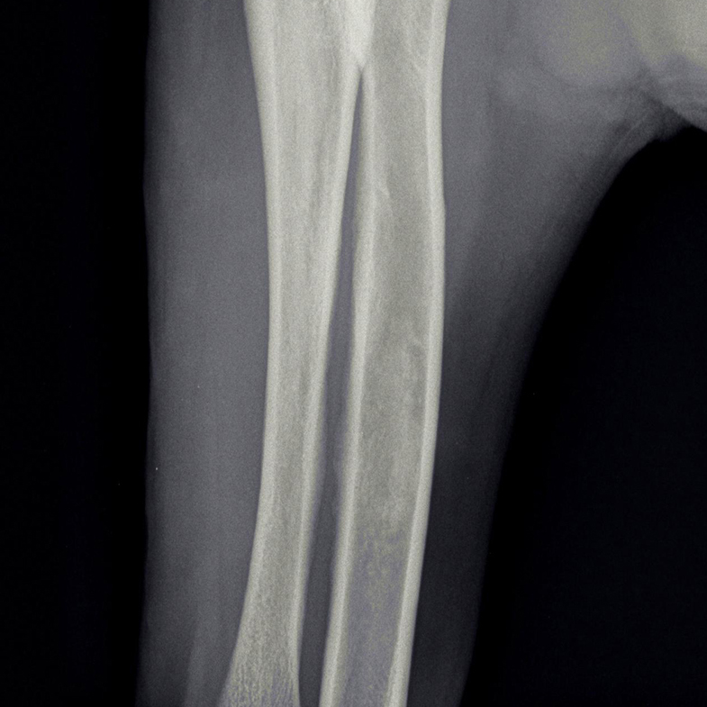 afbeelding Groeipijn