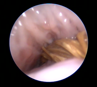 Dierenkliniek Tiel-Drumpt: Vaginoscopie bij een teef, er zitten grasaren in de fossa